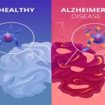 Alzheimer’s Disease Treatment