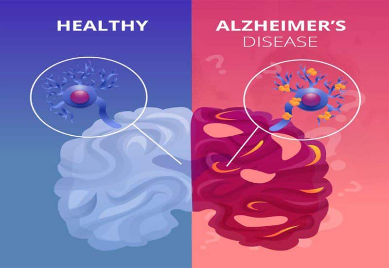 Alzheimer's Disease Treatment