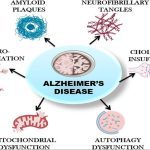 Alzheimer’s Disease Treatment