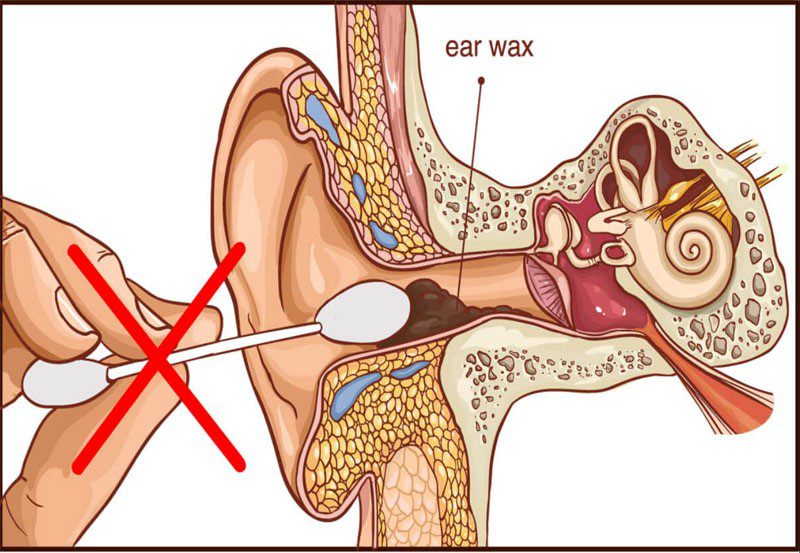 Hearing Loss