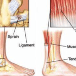 Common Causes of Back Pain